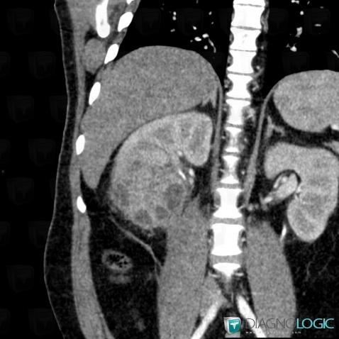 Pyelonephritis, Kidney, CT