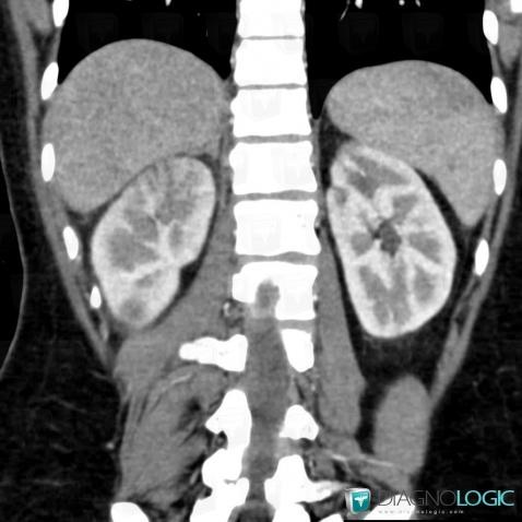 Pyelonephritis, Kidney, CT