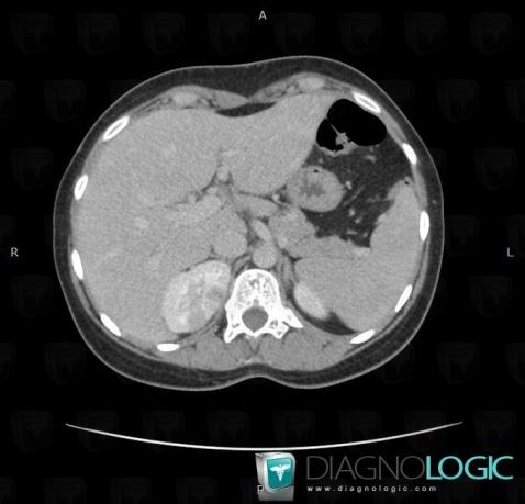 Pyelonephritis, Kidney, CT