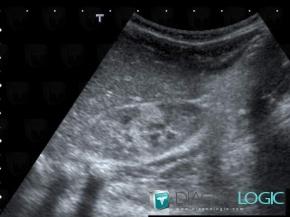 Pyelonephritis, Kidney, US