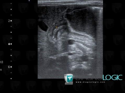 Pyloric stenosis, Stomach, US