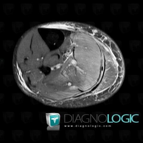 Pyomyositis, Muscles - Leg, MRI