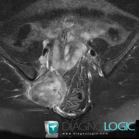 Pyomyositis, Other soft tissues/nerves - Pelvis, MRI