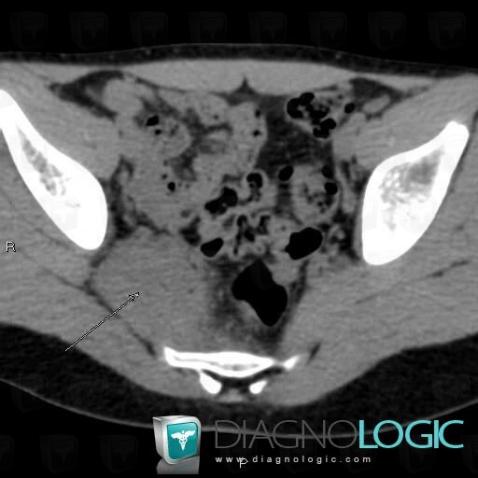 Pyomyositis, Pelvic Muscles, CT