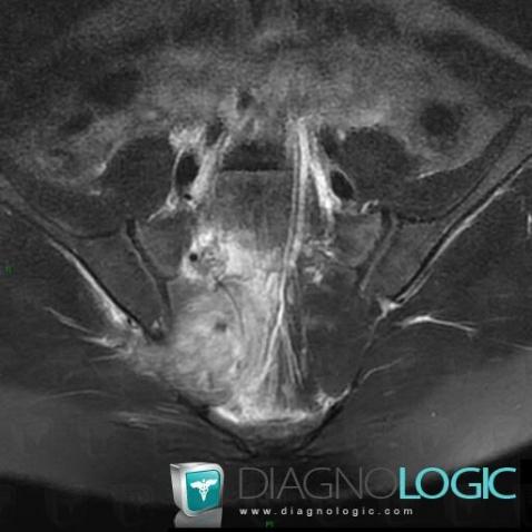 Pyomyositis, Pelvic Muscles, MRI