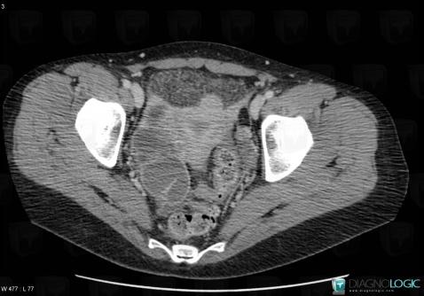 Pyosalpinx, Adnexa / Ovary fallopian tube, CT