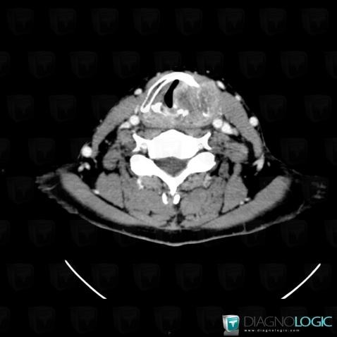 Pyriform sinus carcinoma, Larynx, CT