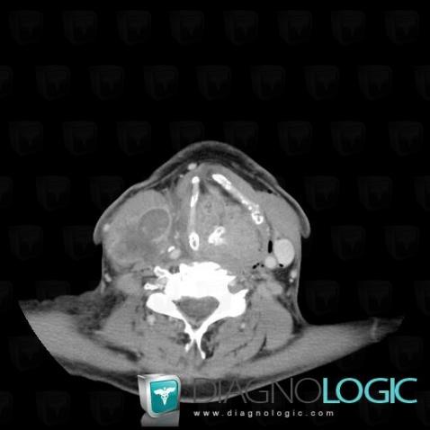 Pyriform sinus carcinoma, Larynx, CT