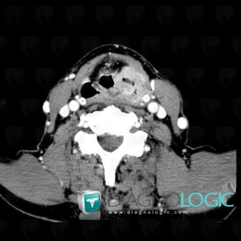 Pyriform sinus carcinoma, Pharyngolarynx, CT