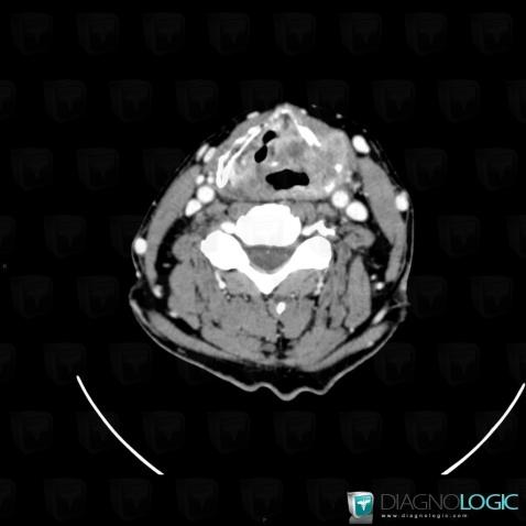 Pyriform sinus carcinoma, Pharyngolarynx, CT