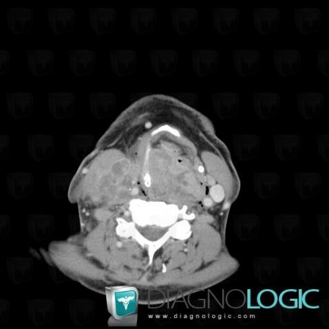 Pyriform sinus carcinoma, Pharyngolarynx, CT