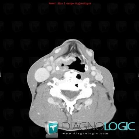 Pyriform sinus carcinoma, Pharyngolarynx, CT