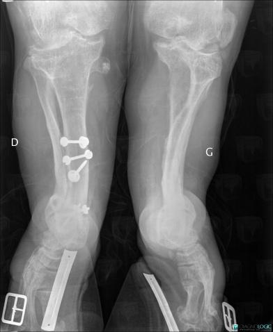 Rachitisme, Tibia -moyen, Fibula -moyen, Radio