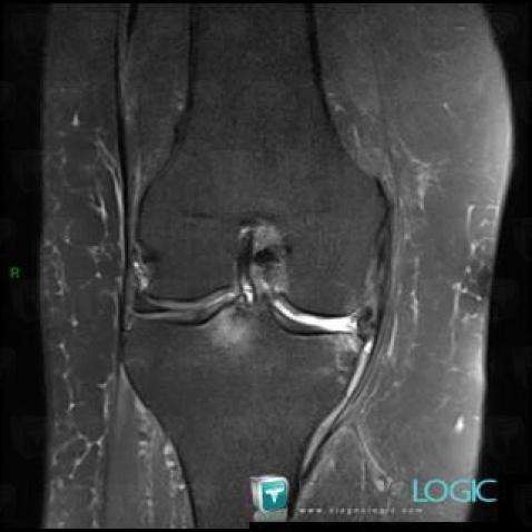 Radial meniscal tear, Meniscus, MRI