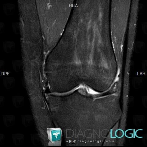 Radial meniscal tear, Meniscus, MRI