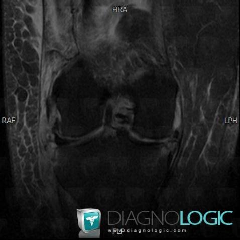 Radial meniscal tear, Meniscus, MRI