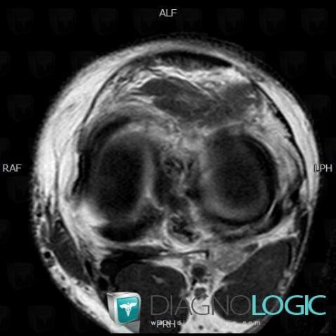 Radial meniscal tear, Meniscus, MRI