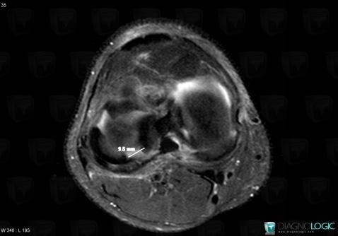 Radial meniscal tear, Meniscus, MRI