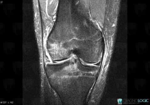 Radial meniscal tear, Meniscus, MRI