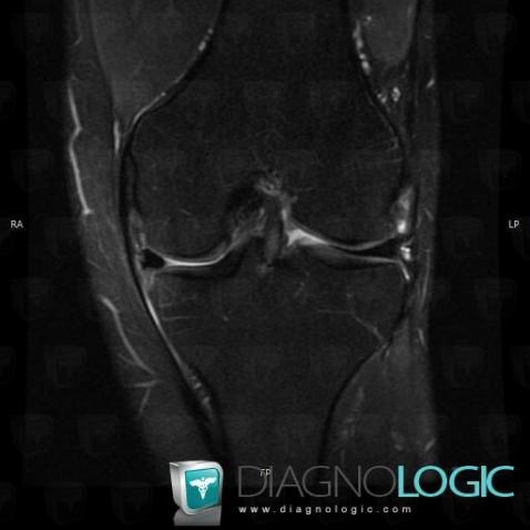 Radial meniscal tear, Meniscus, MRI