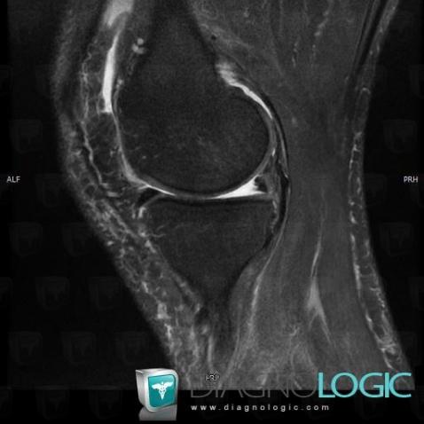 Radial meniscal tear, Meniscus, MRI