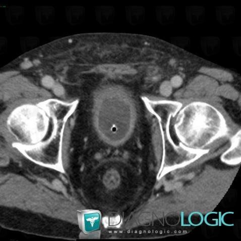 Radiation cystitis, Urinary bladder, CT