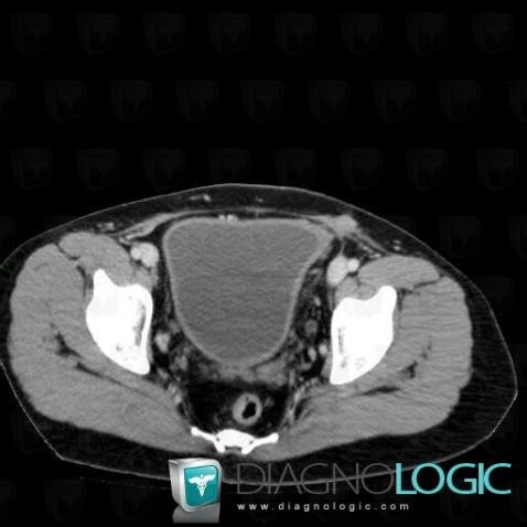 Radiation cystitis, Urinary bladder, CT