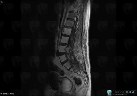 Radiation injury to bones, Vertebral body / Disk, MRI