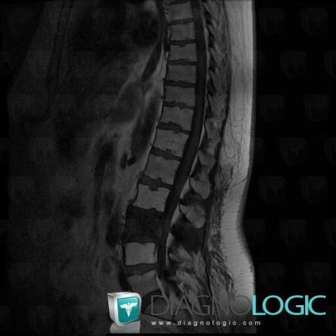 Radiation injury to bones, Vertebral body / Disk, MRI