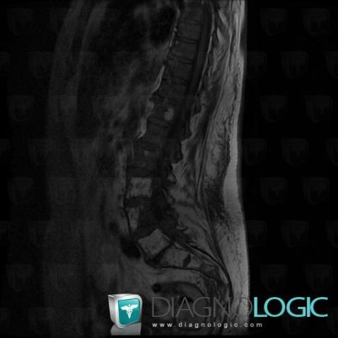 Radiation injury to bones, Vertebral body / Disk, MRI