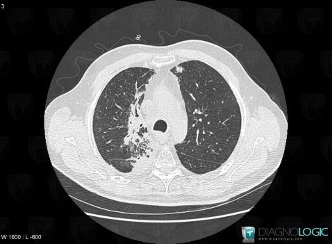 Radiation pneumonitis, Pulmonary parenchyma, CT