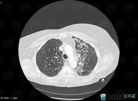 Radiation pneumonitis, Pulmonary parenchyma, CT