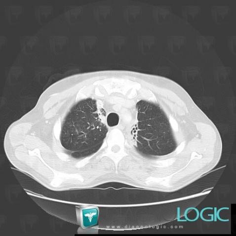 Radiation pneumonitis, Pulmonary parenchyma, CT