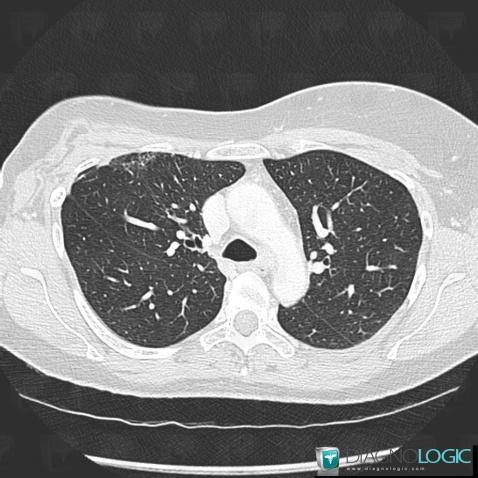 Radiation pneumonitis, Pulmonary parenchyma, CT