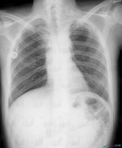 Radiation pneumonitis, Pulmonary parenchyma, X rays