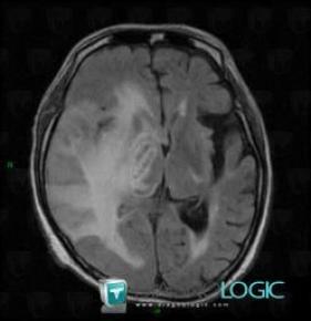 Radiation therapy lesion, Basal ganglia and capsule, MRI