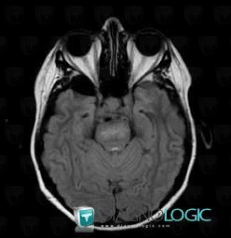 Radiation therapy lesion, Brainstem, MRI