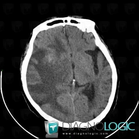 Radiation therapy lesion, Cerebral hemispheres, Basal ganglia and capsule, CT