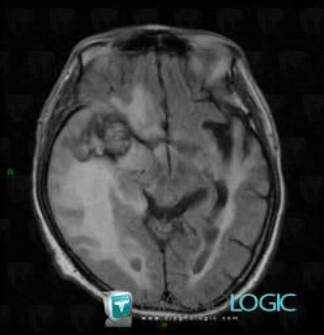 Radiation therapy lesion, Cerebral hemispheres, MRI