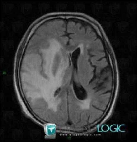 Radiation therapy lesion, Ventricles / Periventricular region, MRI