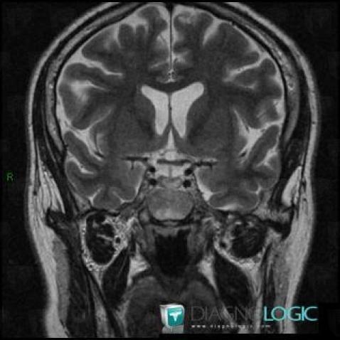 Rathke cleft cyst, Pituitary gland and parasellar region, MRI