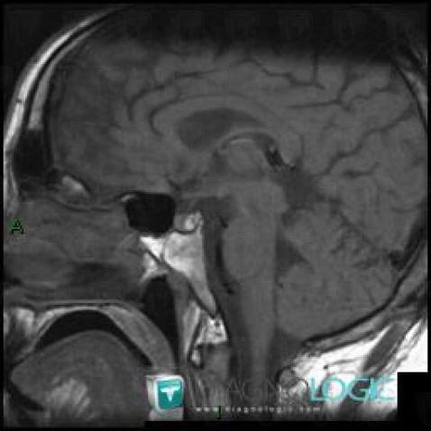 Rathke cleft cyst, Pituitary gland and parasellar region, MRI