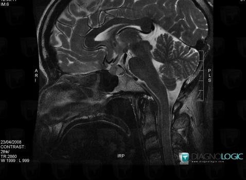 Rathke cleft cyst, Pituitary gland and parasellar region, MRI