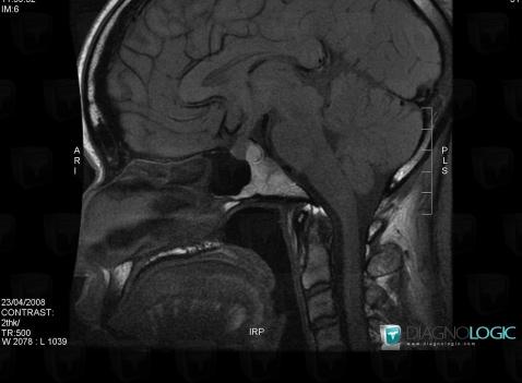 Rathke cleft cyst, Pituitary gland and parasellar region, MRI