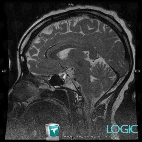 Rathke cleft cyst, Pituitary gland and parasellar region, MRI