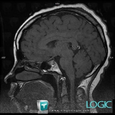 Rathke cleft cyst, Pituitary gland and parasellar region, MRI