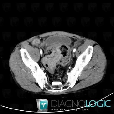 Rectal cancer, Rectum, CT