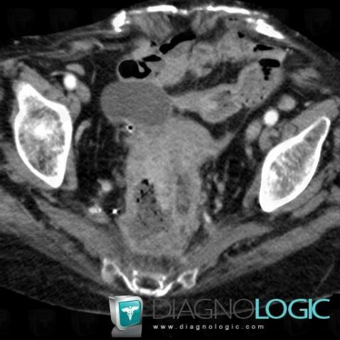 Rectal cancer, Rectum, CT