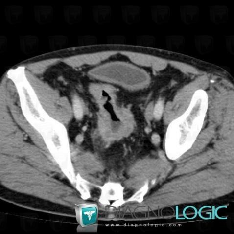 Rectal cancer, Rectum, CT