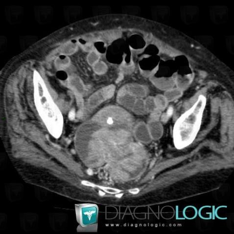 Rectal cancer, Rectum, CT